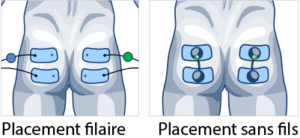 schémas du placement des électrodes sur fessier