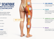 Schéma anatomique du nerf sciatique montrant les principales zones de placement des électrodes pour l’électrostimulation.